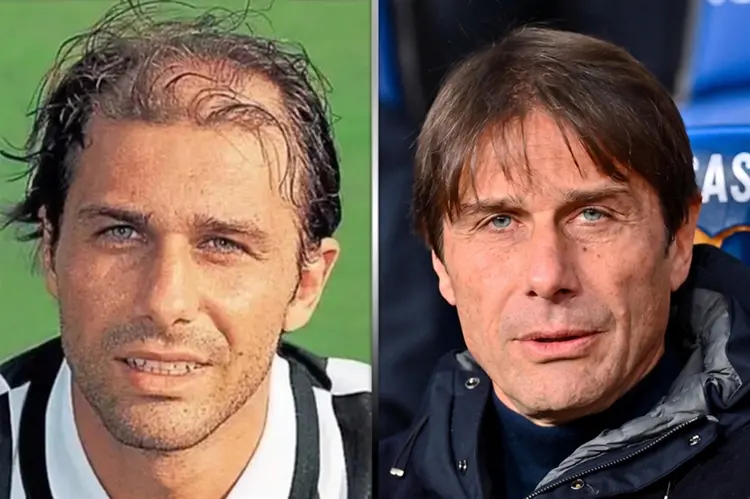 Antonio Conte Hair Transplant: Before and After
