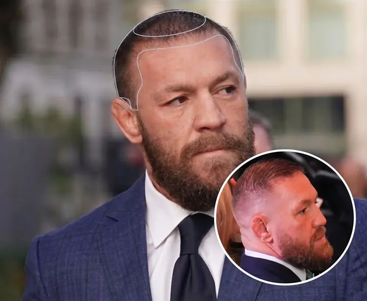 Conor McGregor Hair Transplant: Before and After