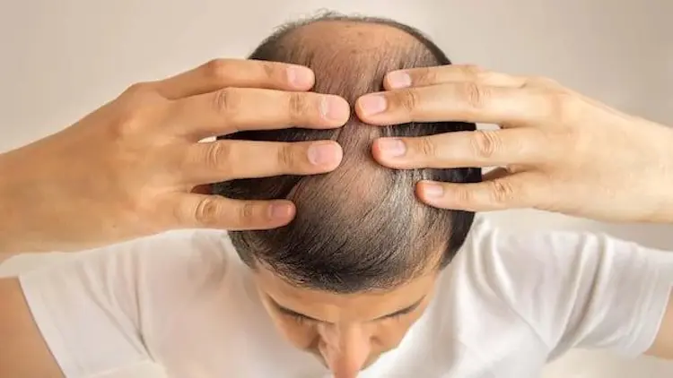 Finasteride for Hair Loss: What is Finasteride?
