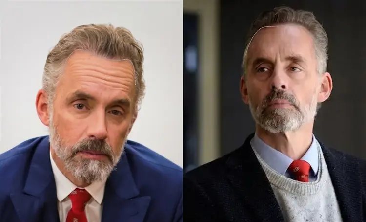 Jordan Peterson Hair Transplant: Before and After