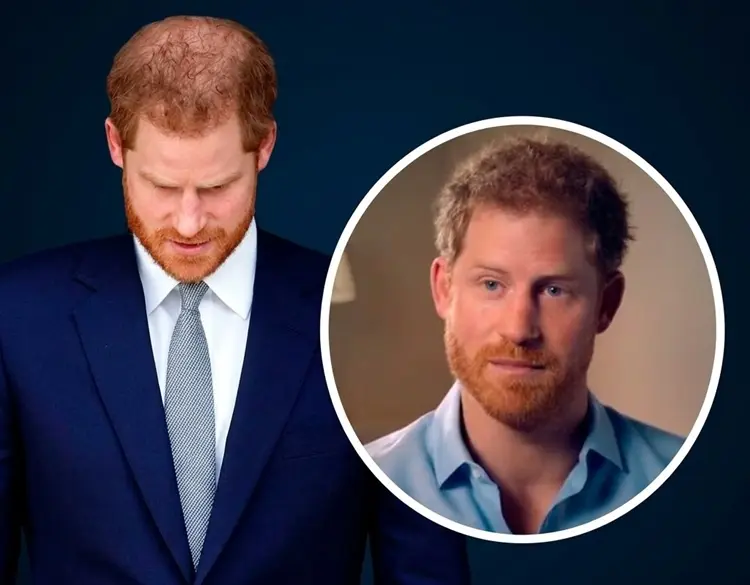 Prince Harry Hair Transplant: Before and After