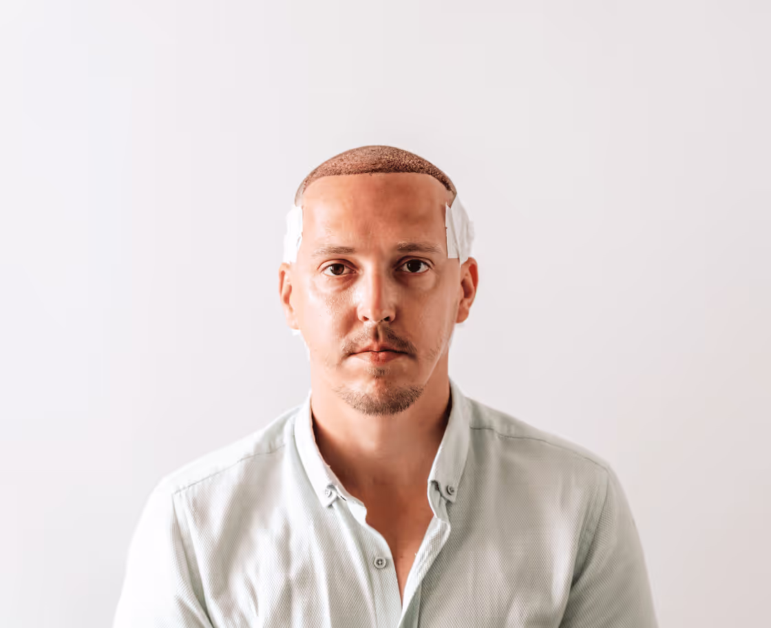 Expected Results & Benefits of FUE Hair Transplant