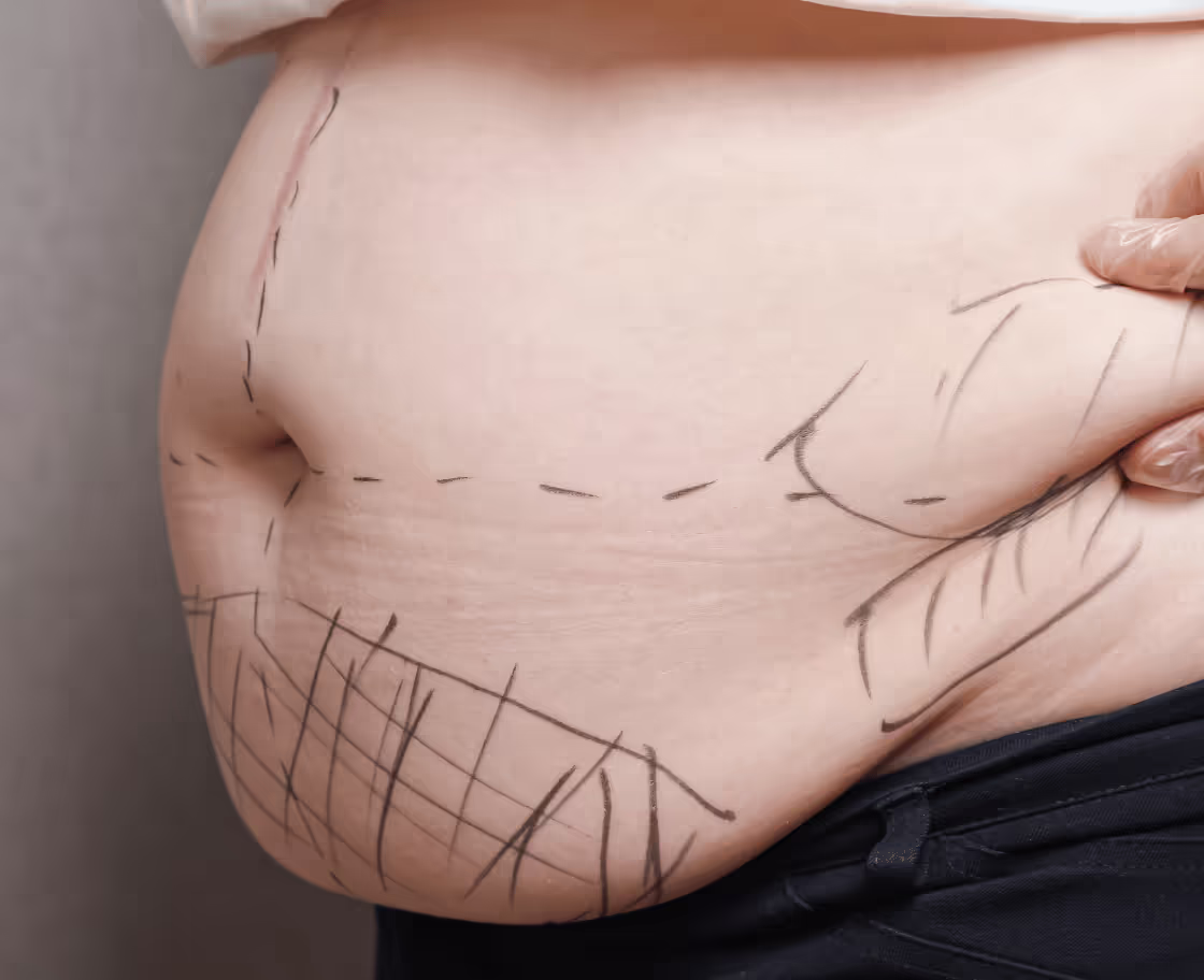 Liposuction Nedir?