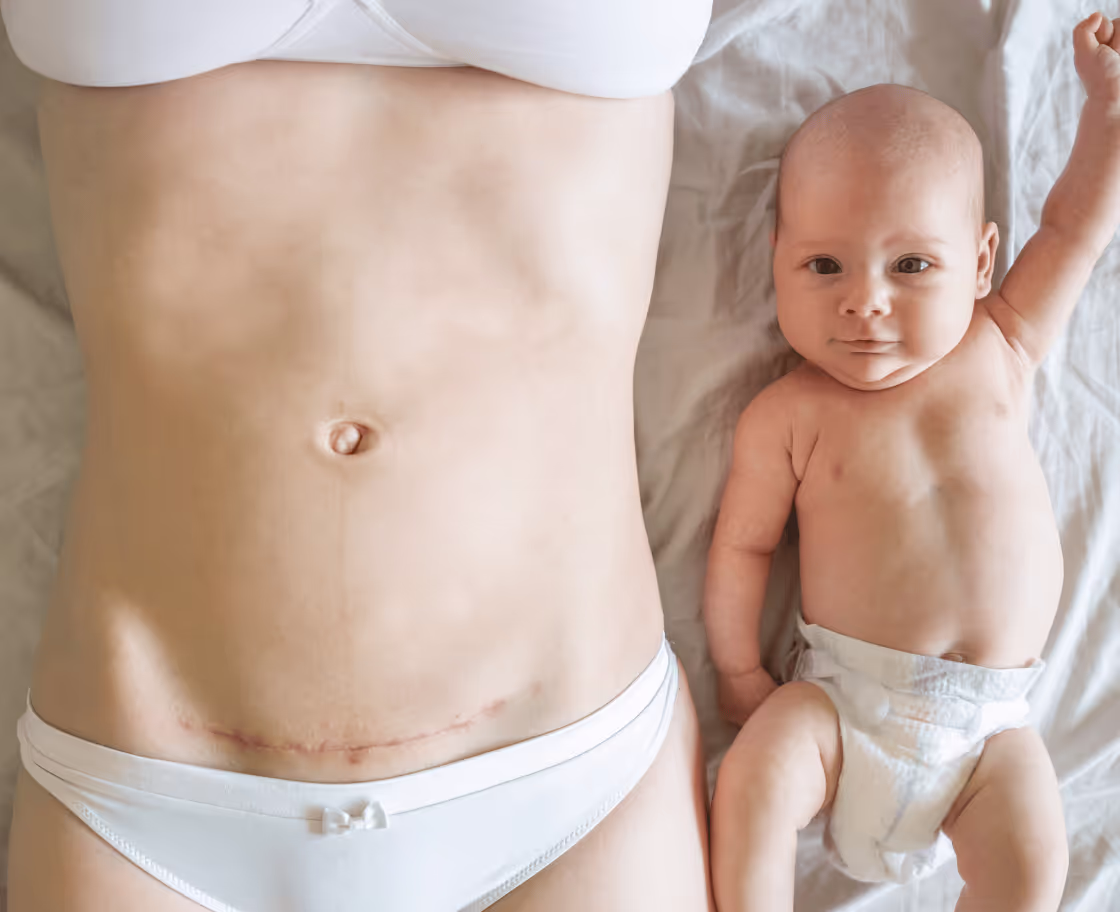 Was ist ein Mommy Makeover?