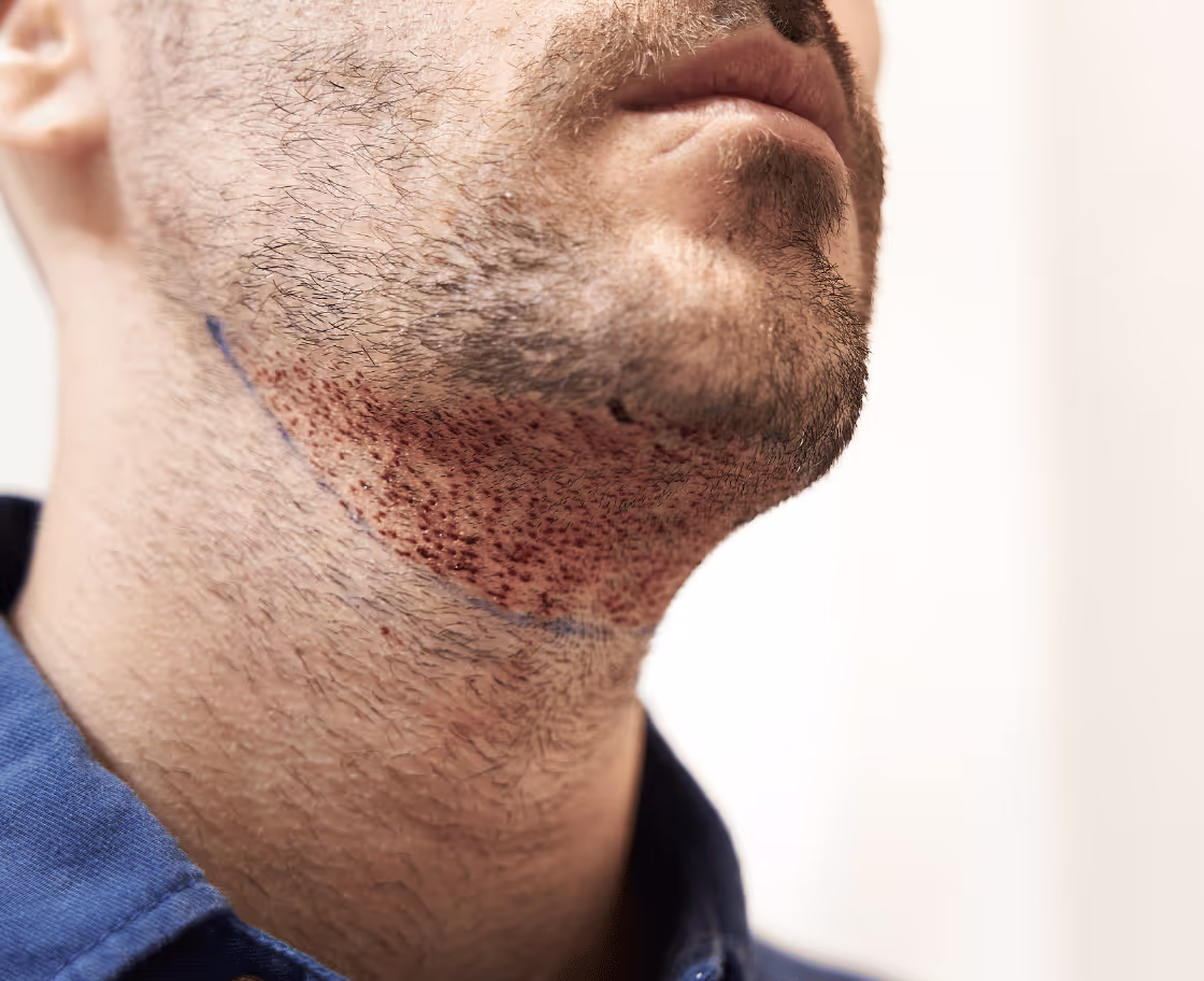 Was ist eine Barttransplantation?