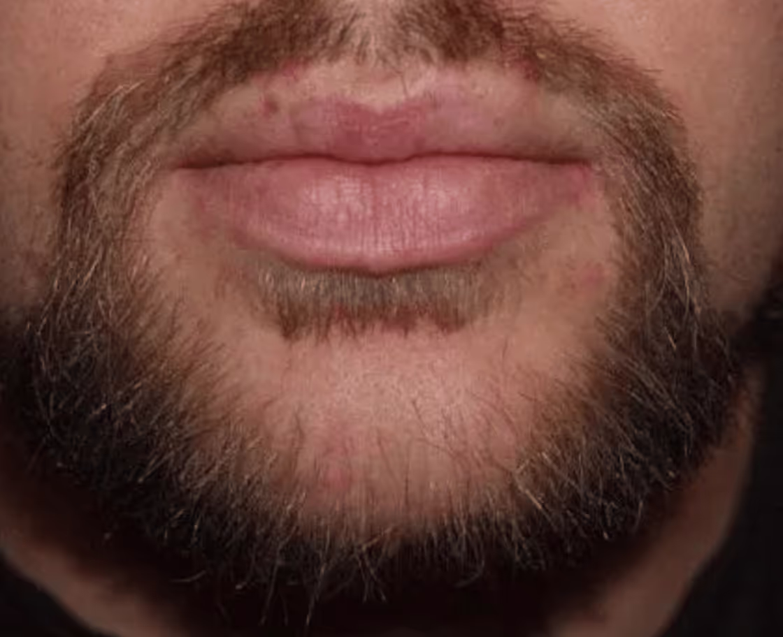 Was ist eine Schnurrbarttransplantation?