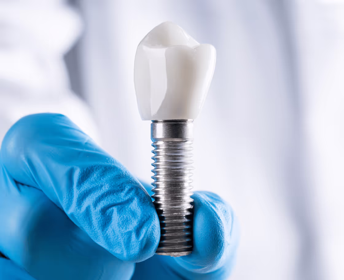 What Is All on 6 Dental Implants Surgery?