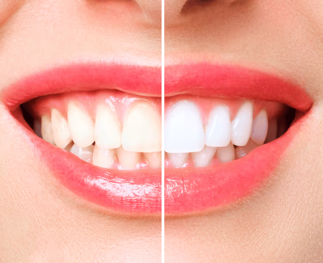Who Can Benefit from Tooth Whitening?