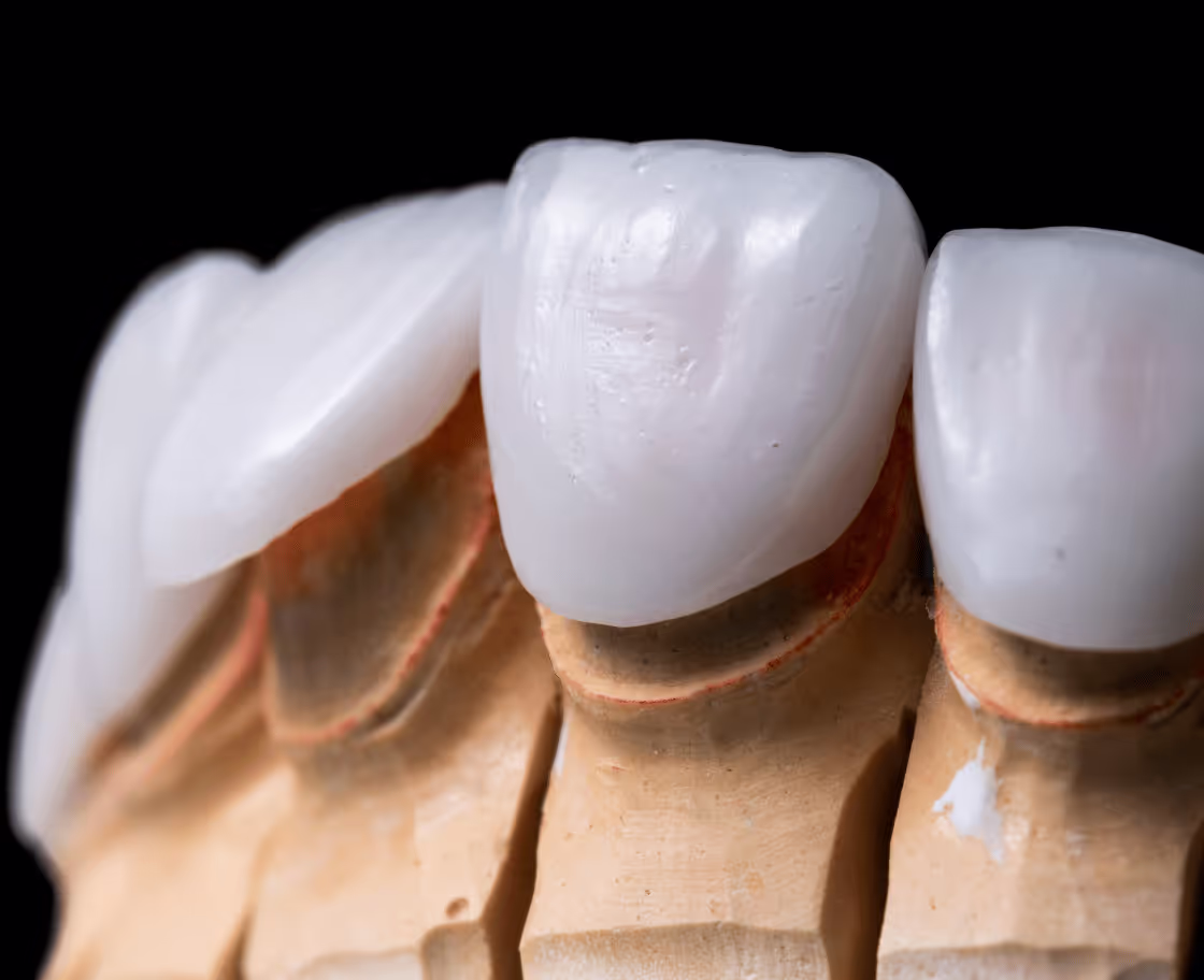 Who Can Benefit from Zirconium Tooth Veneers?