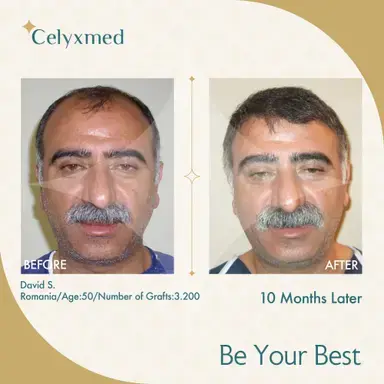 DHI Hair Transplant in Turkey