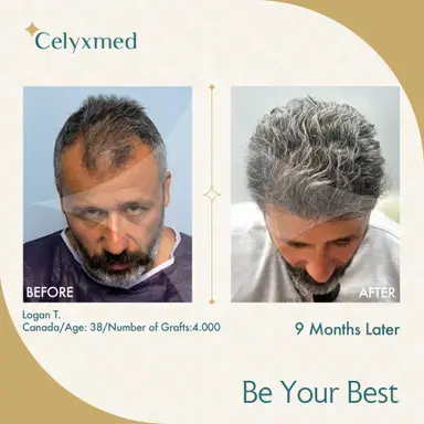 FUE Hair Transplant in Turkey