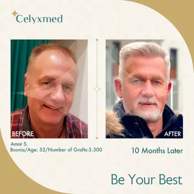 FUE Hair Transplant in Turkey