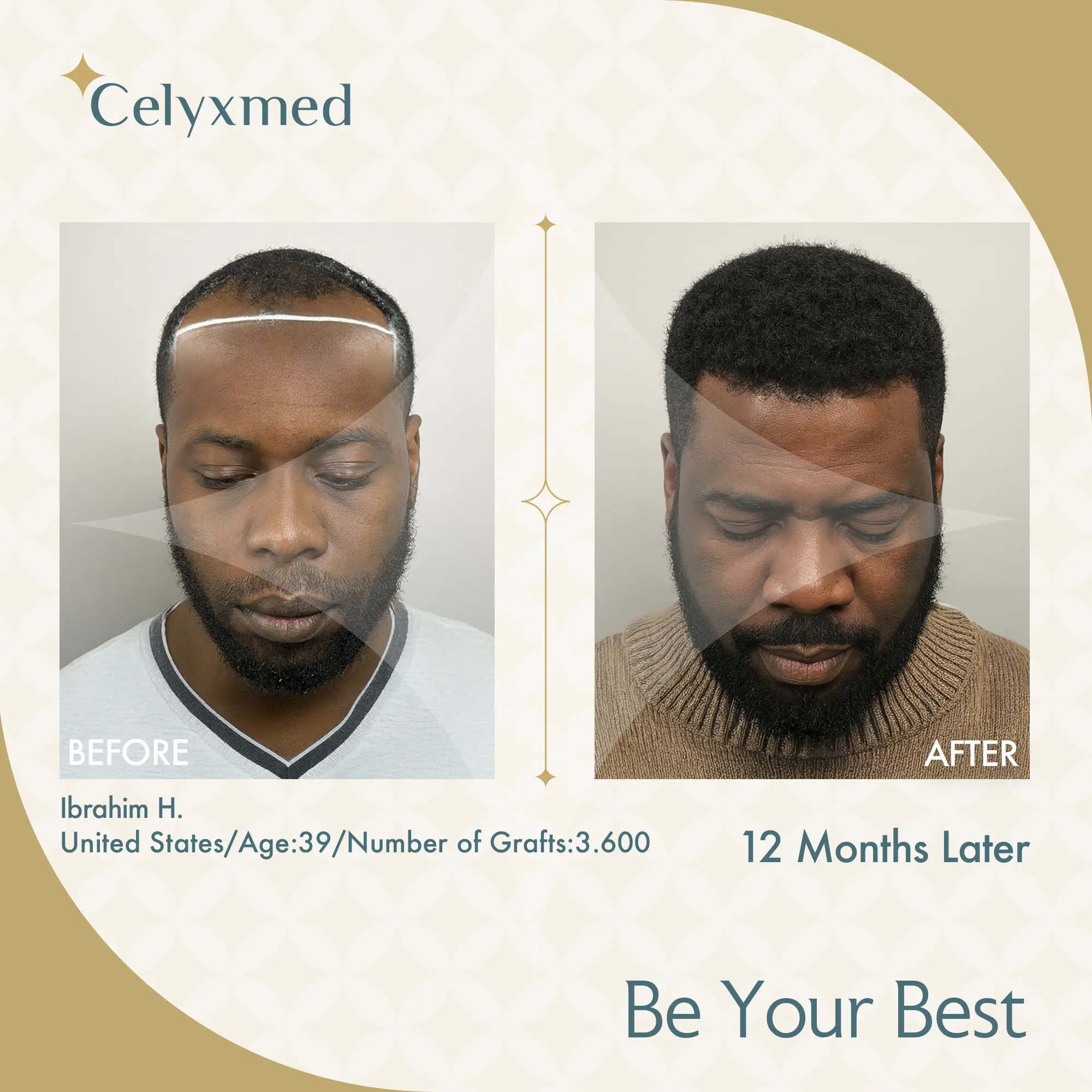 Afro-American Hair Transplant in Turkey