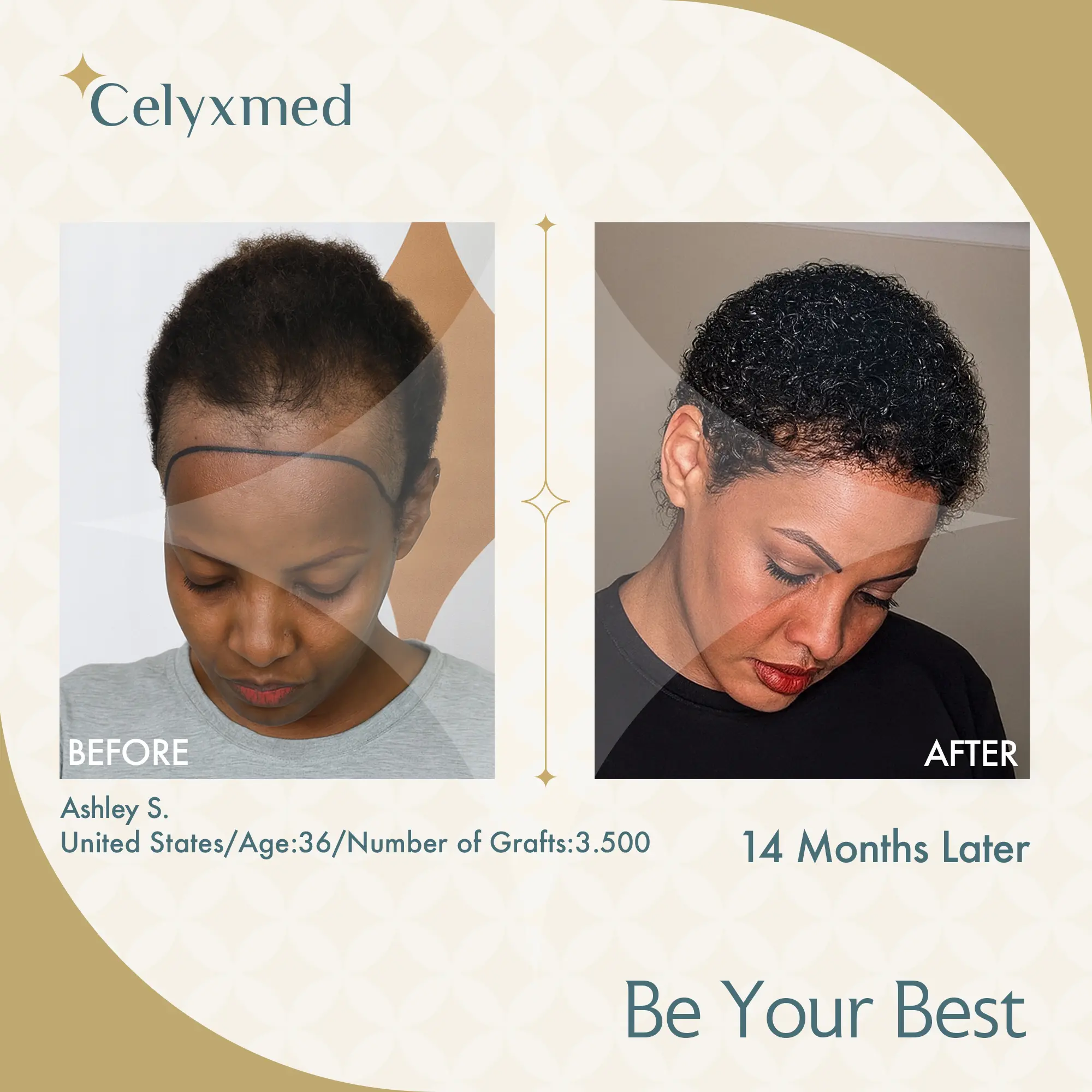 Afro-American Hair Transplant in Turkey