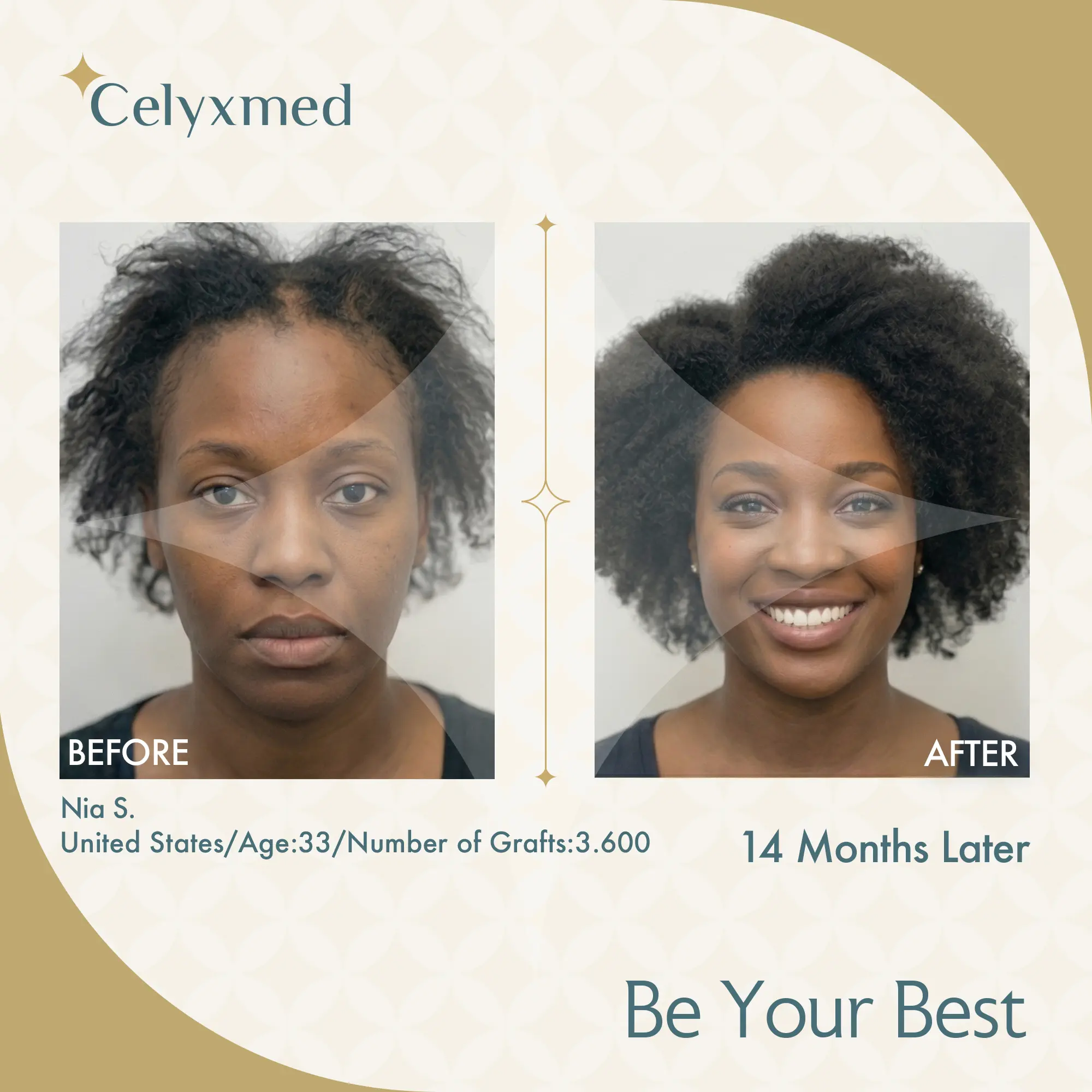 Afro-American Hair Transplant in Turkey