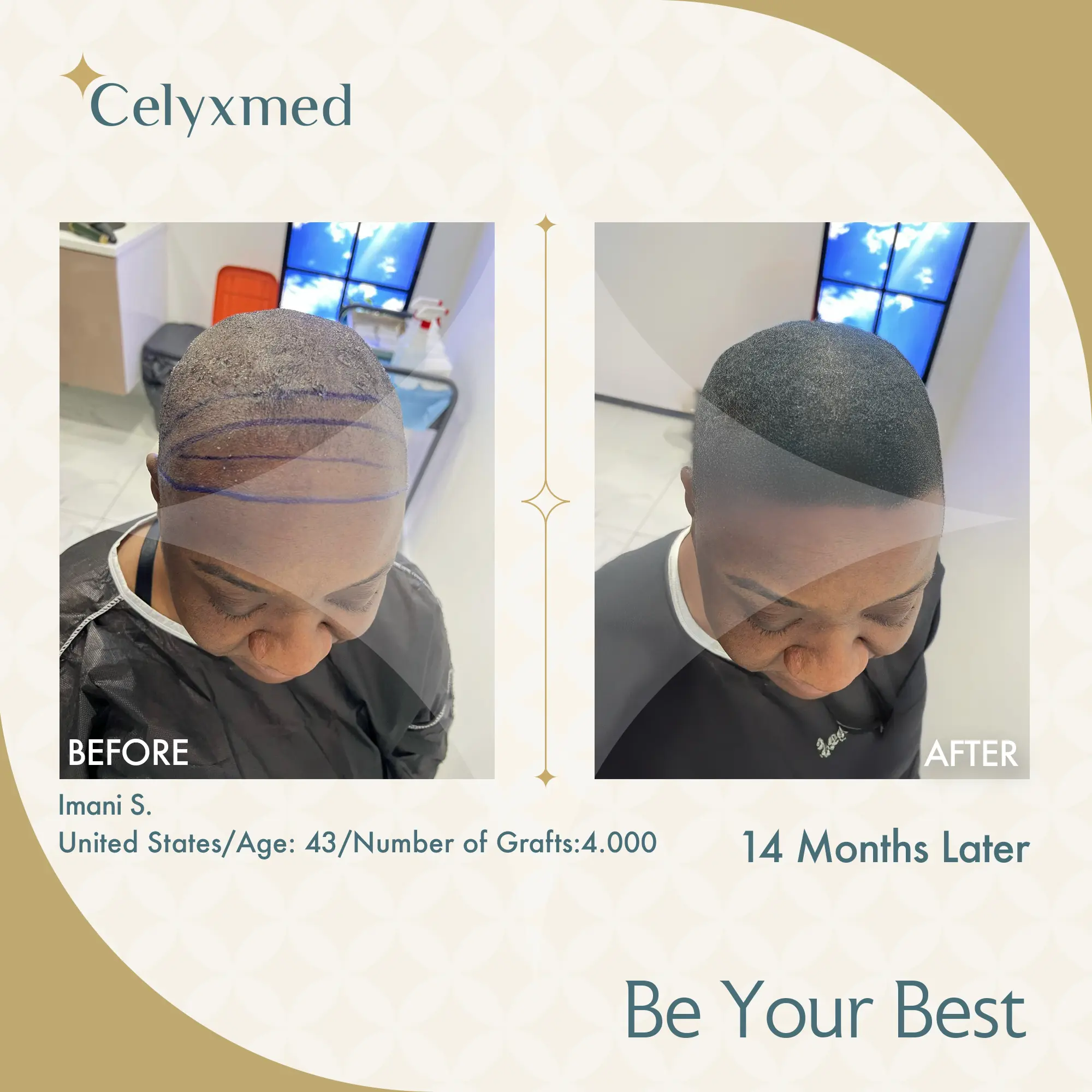 Afro-American Hair Transplant in Turkey