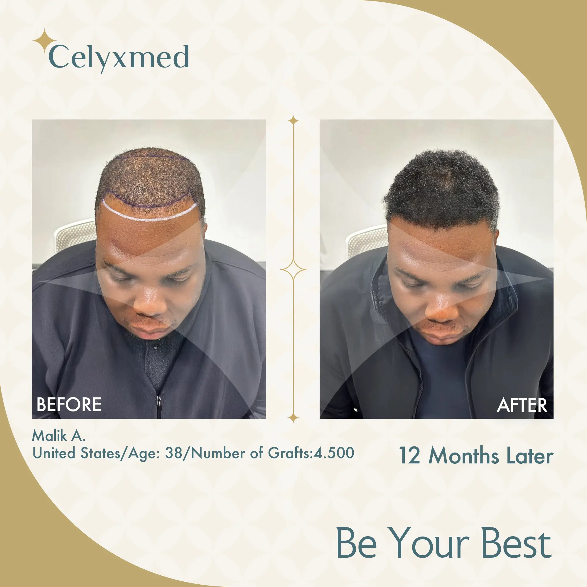 Afro-American Hair Transplant in Turkey