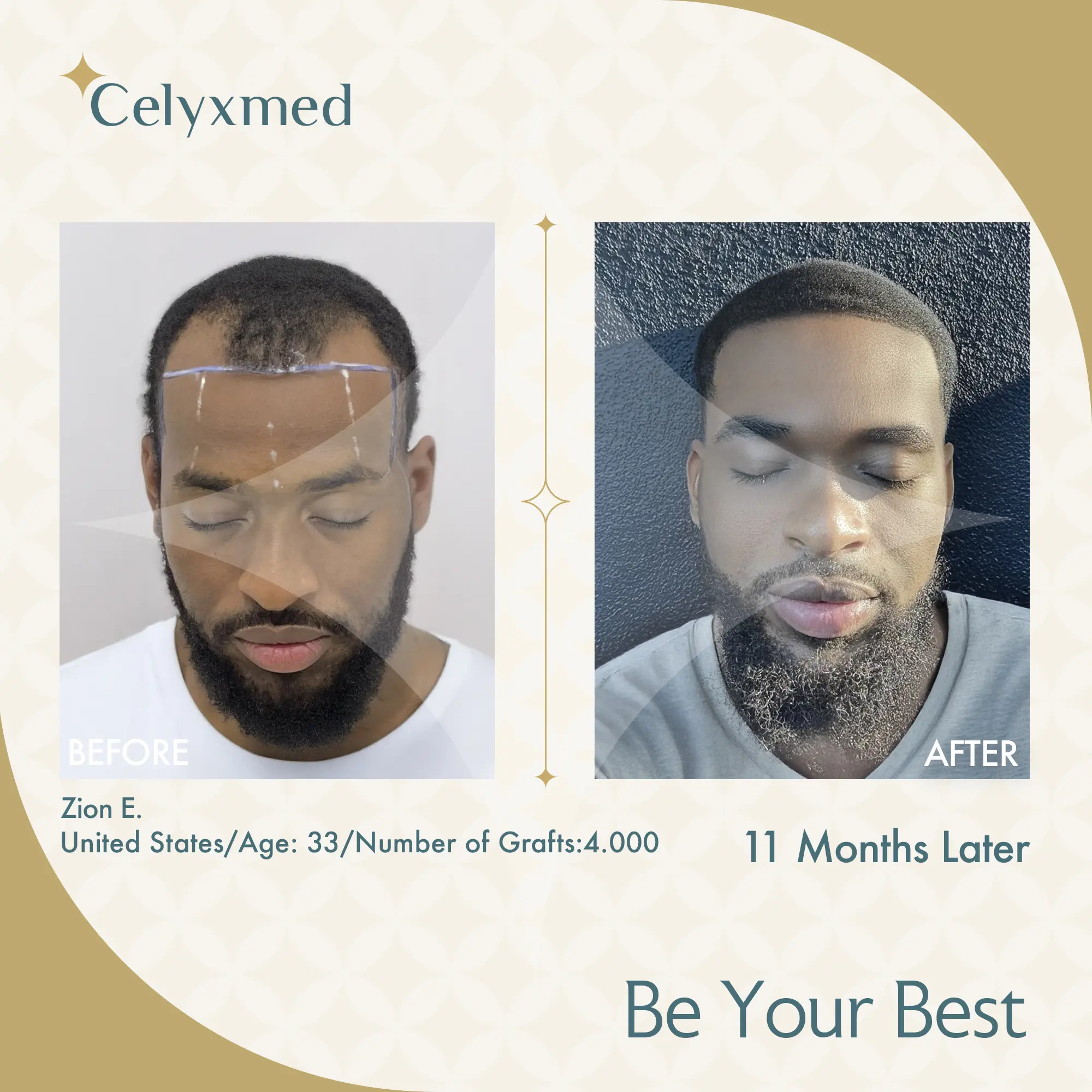 Afro Haartransplantation Türkei |