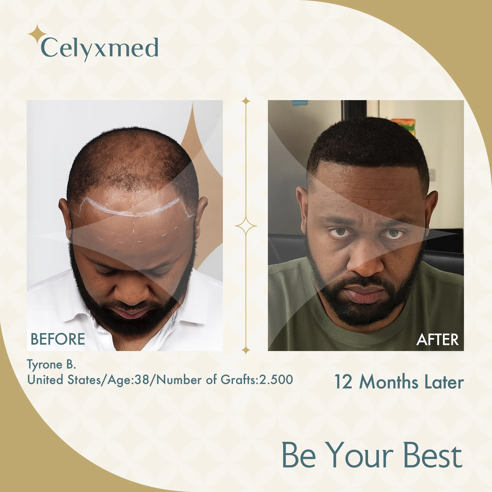 Afro Haartransplantation Türkei |