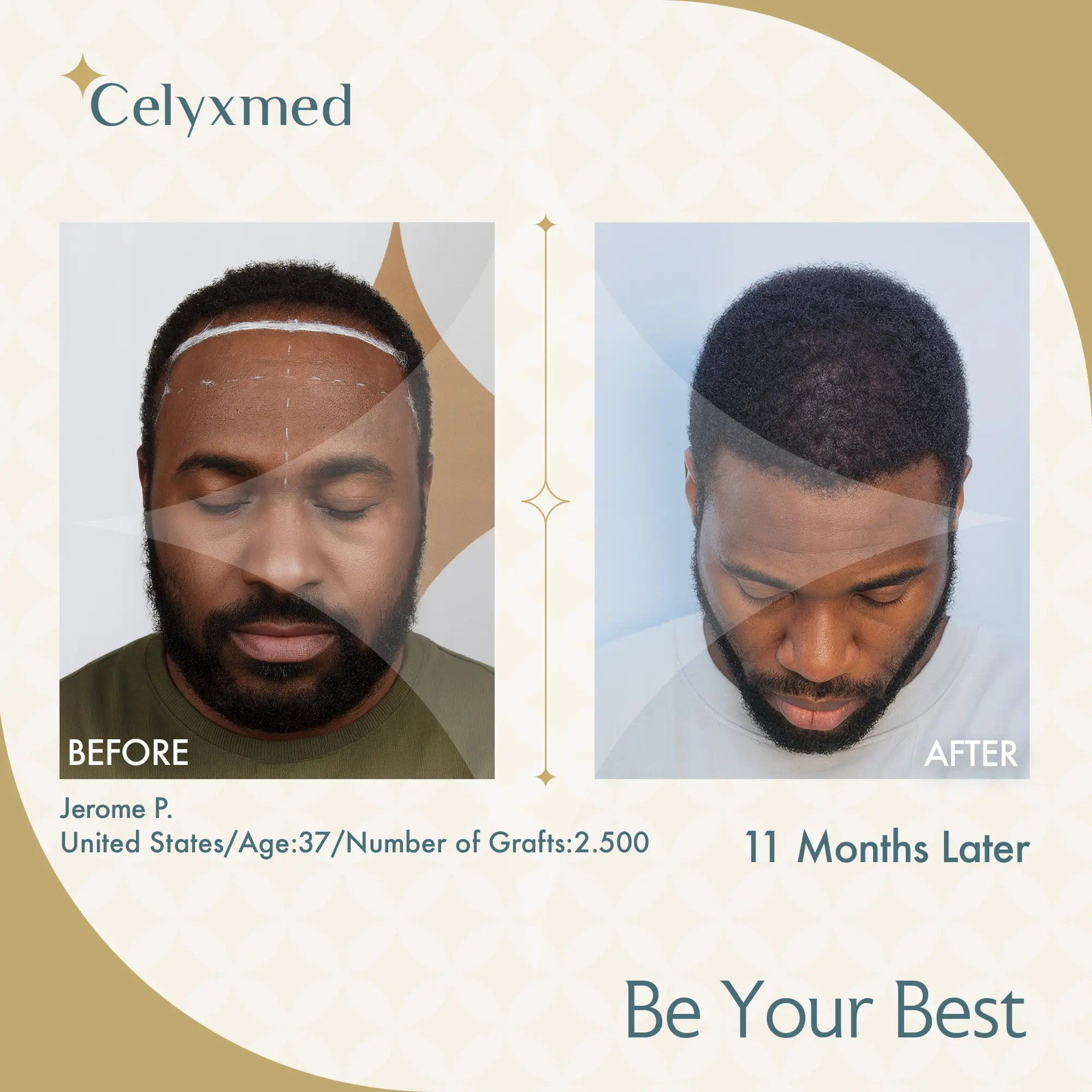 Afro Haartransplantation Türkei |