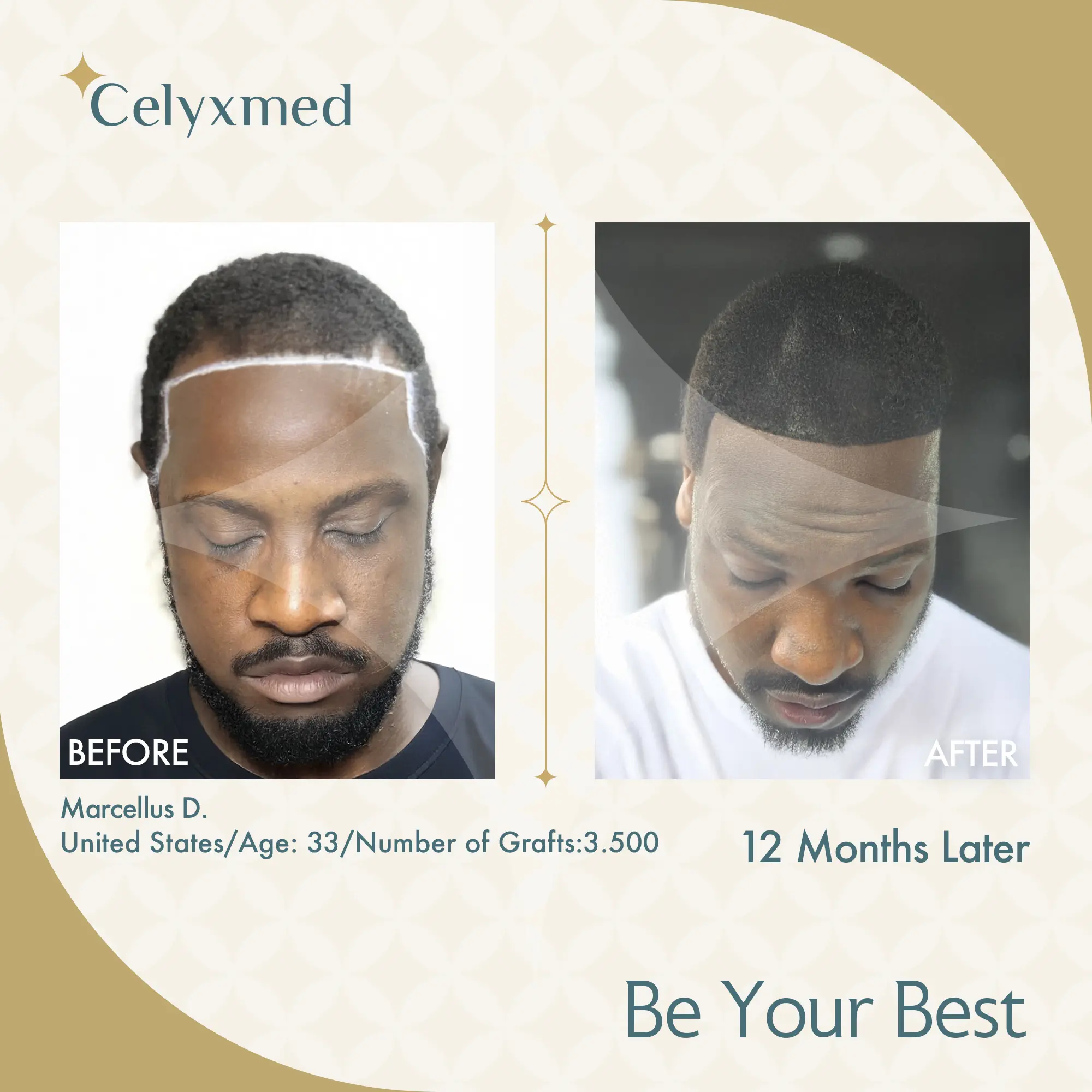 Afro Amerikan Saç Ekimi Türkiye