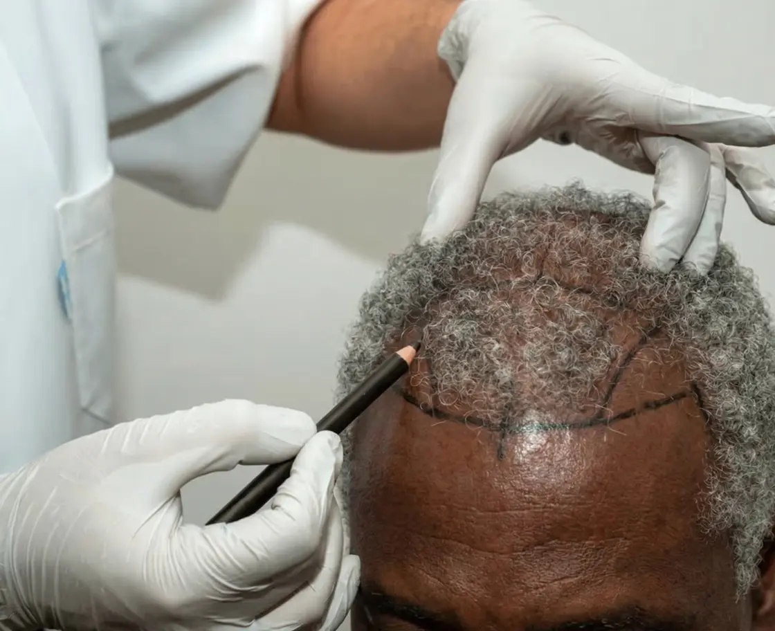 How Is Afro Hair Transplant Performed?