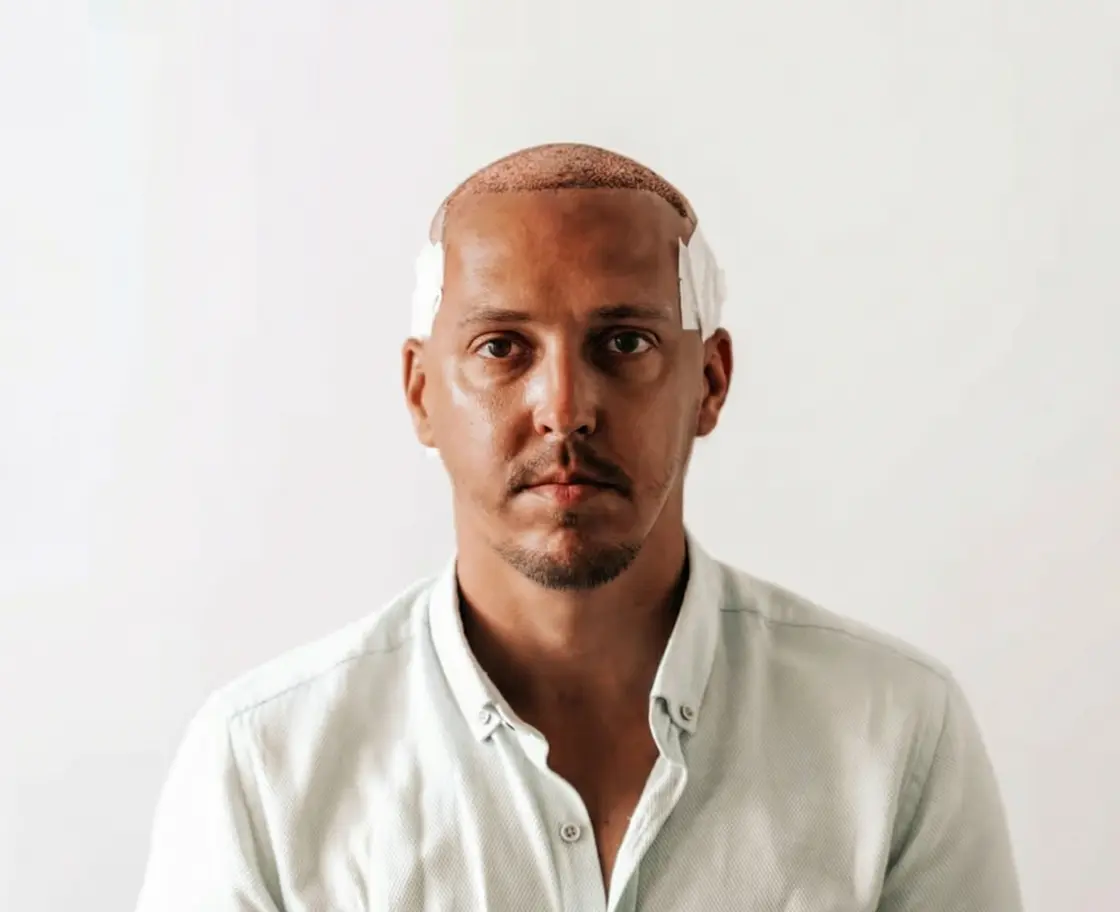 Erwartete Ergebnisse und Vorteile einer FUE-Haartransplantation