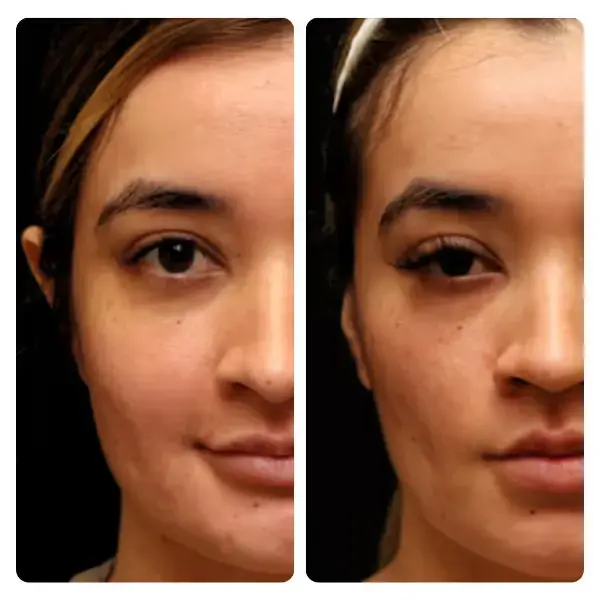 Buccal Fat Removal in Turkey