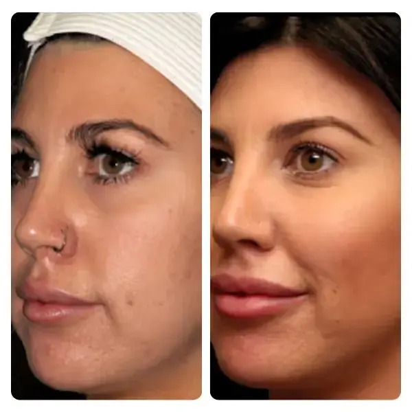 Buccal Fat Removal in Turkey