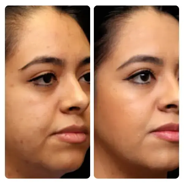 Buccal Fat Removal in Turkey