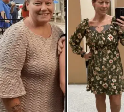 Buccal Fat Removal in Turkey