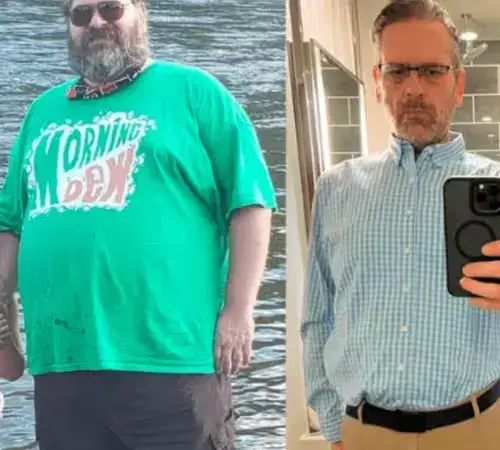 Buccal Fat Removal in Turkey