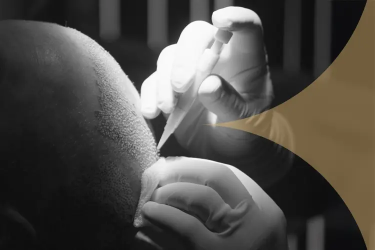 DHI Hair Transplant in Turkey