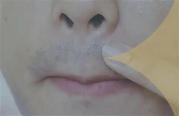Moustache Transplant in Turkey