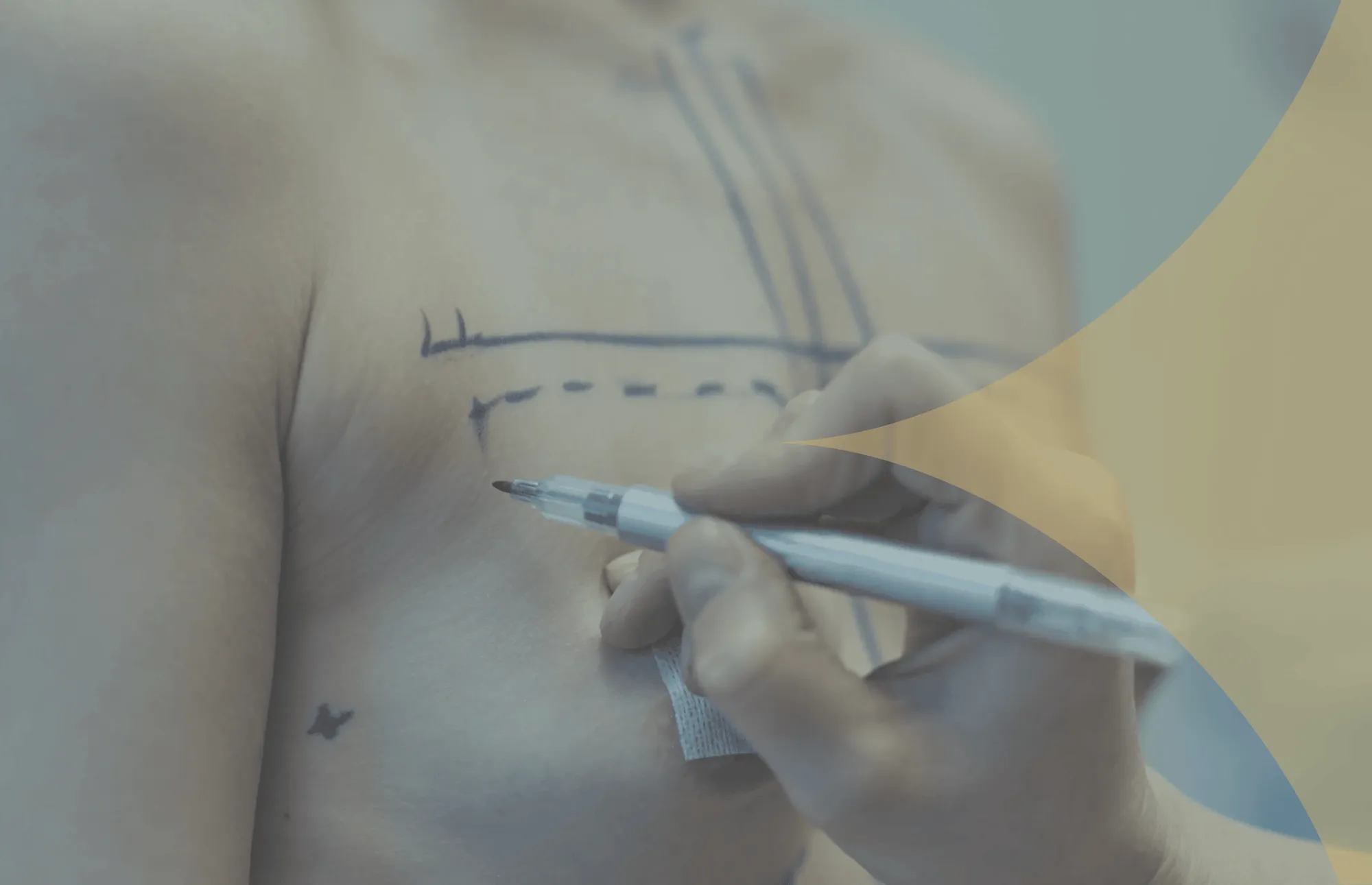 Gynecomastia Surgery in Turkey