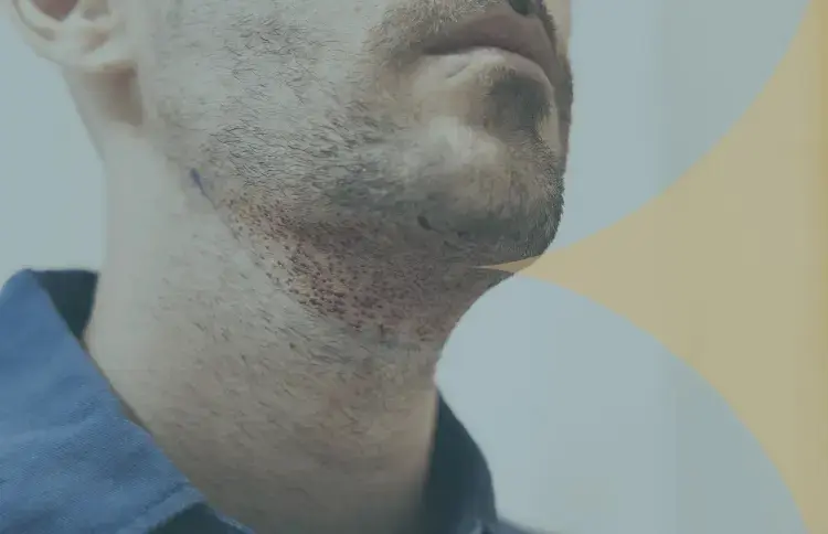 Beard Transplant in Turkey