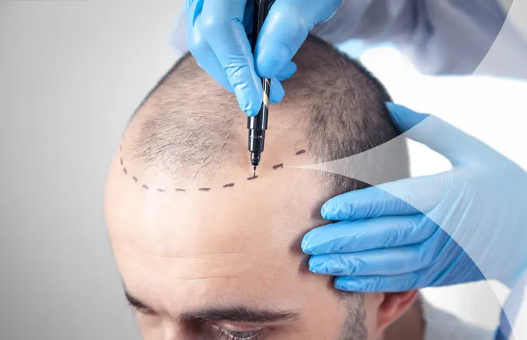 Hair Transplant